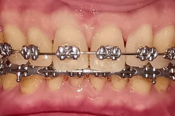 After Braces Case for Dr. Ramon Balane
