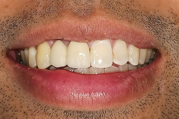 After Cosmtic Bonding Case for Dr. Ramon Balane