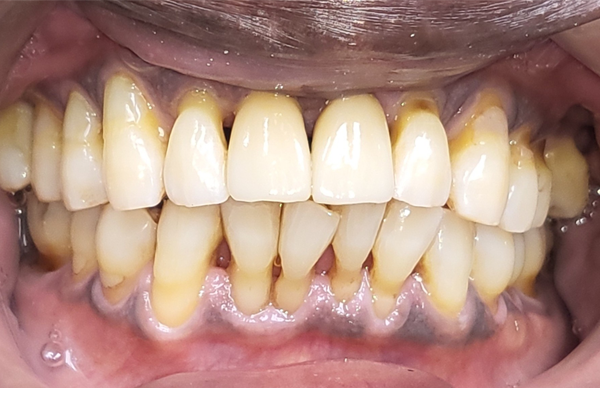 After Dental Implant by Dr. Ramon Balane