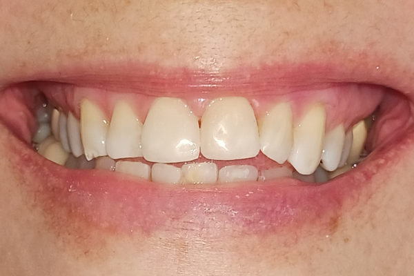 After Porcelain Venners by dr. Ramon Balane