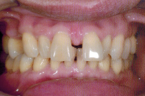 Before Braces Case for Dr. Ramon Balane