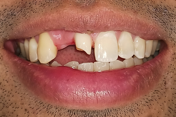 Before Cosmetic Bonding Case for Dr. Ramon Balane