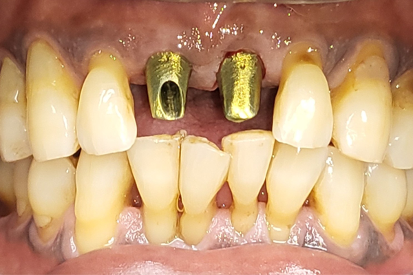 Before Dental Implant by Dr Ramon Balane