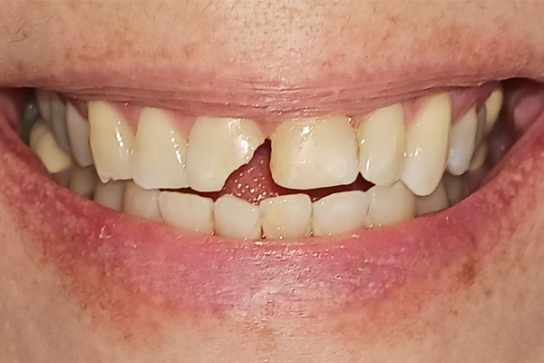 Before Porcelain Veneers by Dr. Ramon Balane